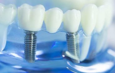 Dental Implants