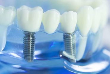 Dental Implants