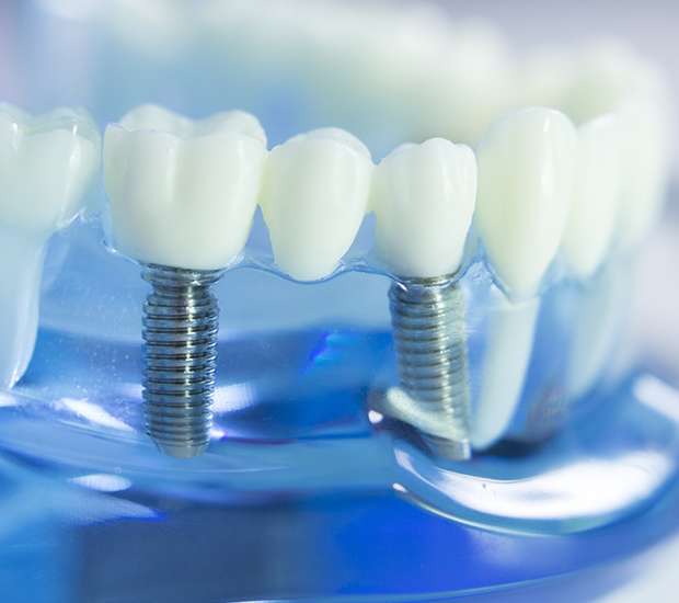 Dental implant